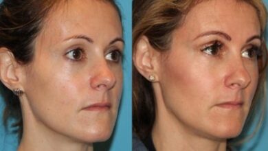 7 Benefits Of Sculptra Injection In Tucson